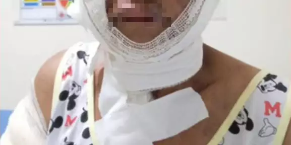 Mulher tem corpo queimado pelo companheiro após tentativa de feminicídio no Pará