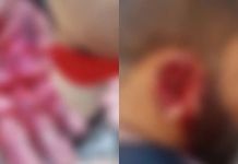 Homem fica gravemente ferido após ataque de pitbull em Itaituba