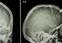 Adolescente fica com faca cravada na cabeça após discussão com irmão mais novo em Portel