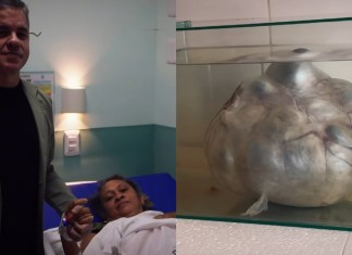 Dr. Alessandro Lobato realiza feito histórico ao retirar cisto de quase 10 kg em Igarapé-Miri